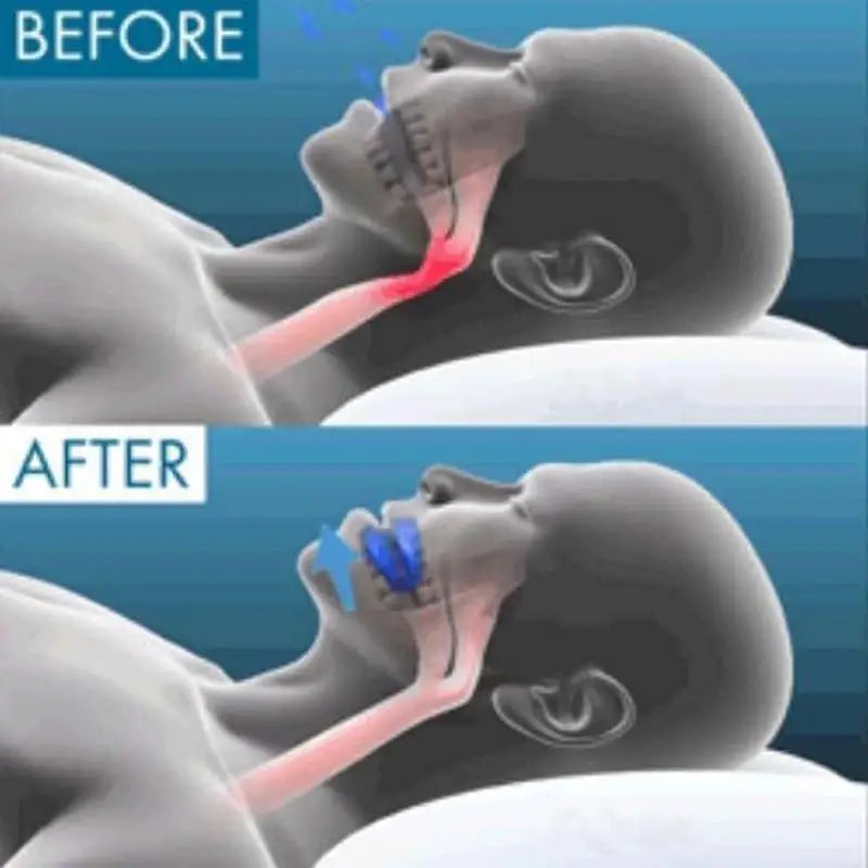 Anti Snoring Mouthpiece Reusable Honex Snore Stoppers Sleep Difficulty Snore Stoppers Solution For Comfort & Easy Breathing
