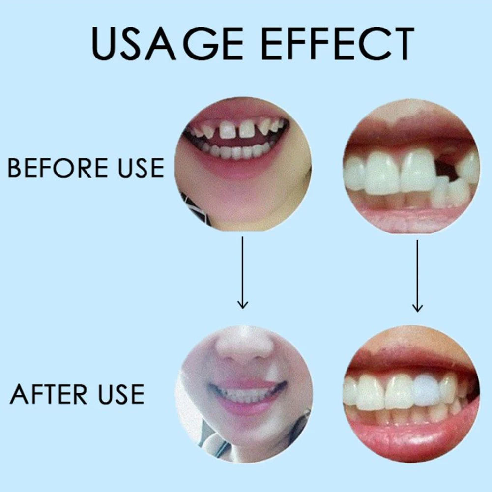 10/100g Dental Glue Handmade Solid Dental Restoration Kit Temporary Cavity Plugging Glue Practical Unisex Adults Teeth Whitening